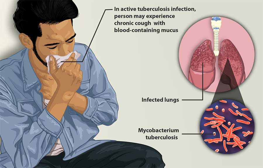 Image of Lungs Infected with Myobacterium Tuberculosis. In active tuberculosis infection, person may experience chronic cough with blood-containing mucus.