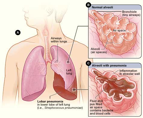 An illustration of pneumonia showing a close-up of the lung with normal alveoli compared to alveoli with pneumonia with fluid, pus, and inflammation