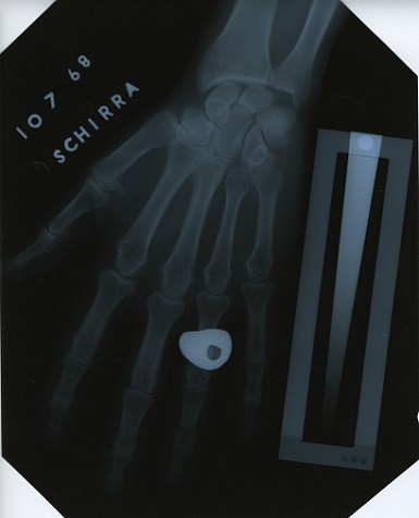 X-ray of the hand of Wally Schirra, a U.S. astronaut.